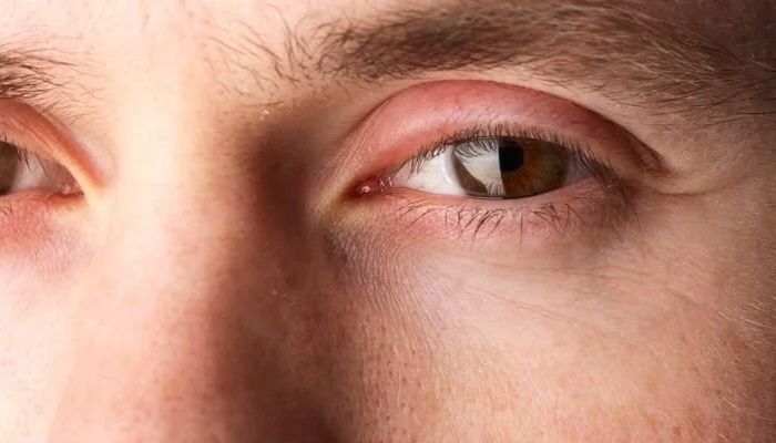ورم پلک نشانه چیست؟ ورم پلک نشانه چیست؟