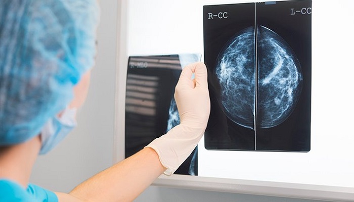 بافت متراکم پستان خطر سرطان را بالا می برد