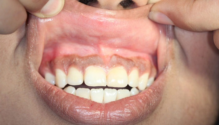 مغز بیماران آلزایمری آلوده به باکتری های لثه مغز بیماران آلزایمری آلوده به باکتری های لثه