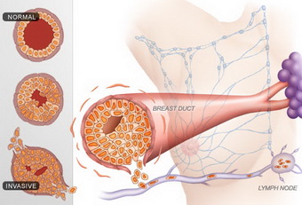 مراحل سرطان پستان