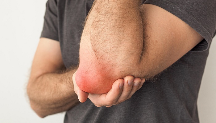 بورسیت چیست و چگونه تشخیص داده می شود؟ بورسیت چیست و چگونه تشخیص داده می شود؟