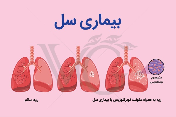 افزایش موارد ابتلا به سل در پاندمی کرونا