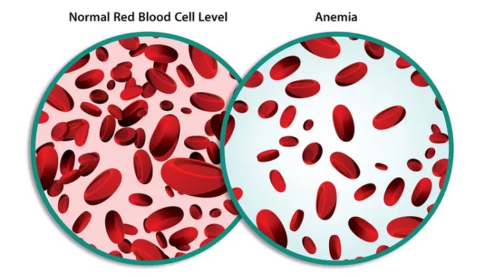 آشنایی با 8 نوع کم خونی نادر و علایم آنها