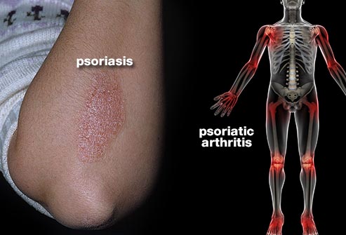 آرتریت پسوریازیس چیست؟