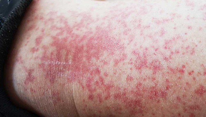 بیماری لیکن پلان چقدر خطرناک است؟ بیماری لیکن پلان چقدر خطرناک است؟