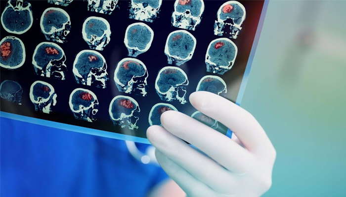 خطر متاستاز مغز در نجات یافتگان از سه سرطان شایع