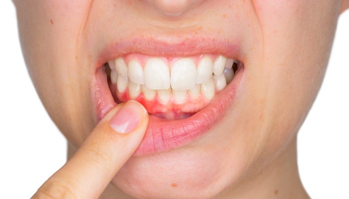 خونریزی لثه نشانه چیست؟ خونریزی لثه نشانه چیست؟