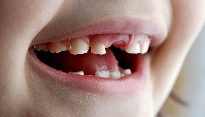 چرا مراقبت از دندان های شیری مهم است؟