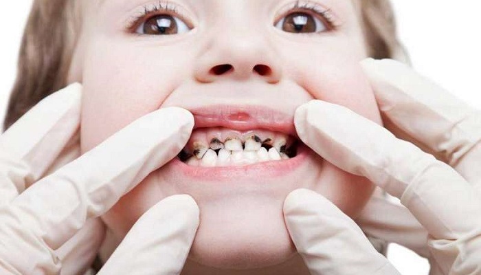 اهمیت توجه به تغییر رنگ دندان کودک