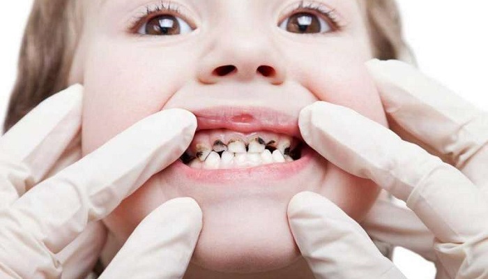 اهمیت توجه به تغییر رنگ دندان کودک اهمیت توجه به تغییر رنگ دندان کودک