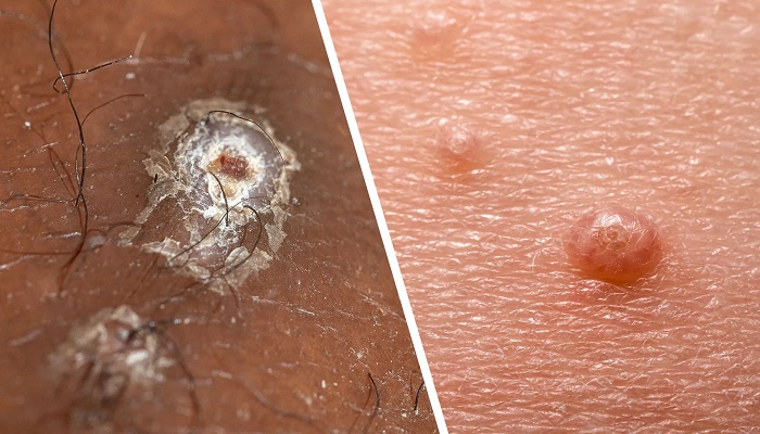 مولوسکوم کنتاژیوزوم؛ علایم و راه های درمان