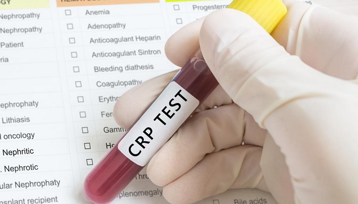 آزمایش خون CRP چیست و چه کاربردی دارد؟