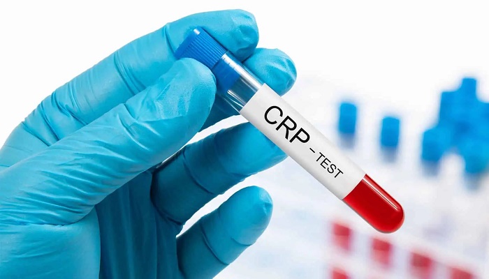 آزمایش پروتئین واکنشی C چیست و چرا انجام می شود؟ آزمایش پروتئین واکنشی C چیست و چرا انجام می شود؟