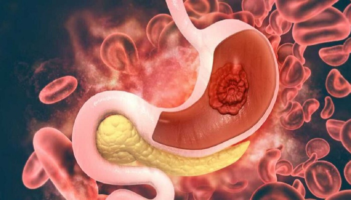 از کجا بفهمیم سرطان معده داریم؟