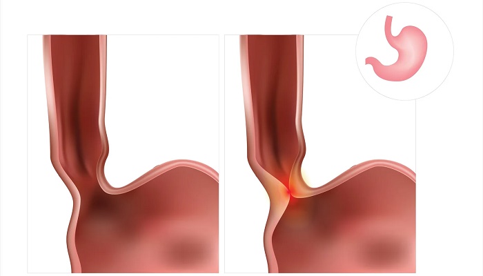 آشالازی چیست؟