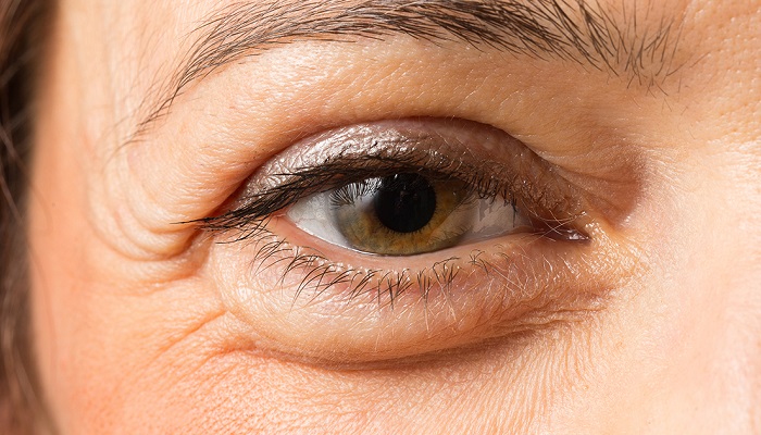 11 علت پف چشم و درمان آن