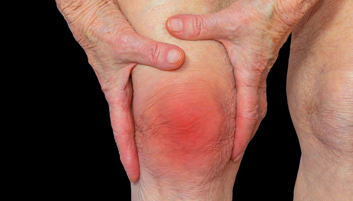 آیا سرما و رطوبت باعث روماتیسم میشوند؟ آیا سرما و رطوبت باعث روماتیسم میشوند؟
