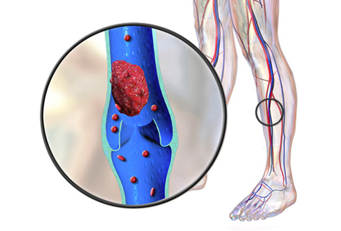 ترومبوز ورید های عمقی (DVT)