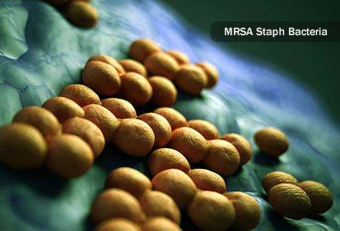استافیلوکوک اورئوس مقاوم به متی سیلین MRSA