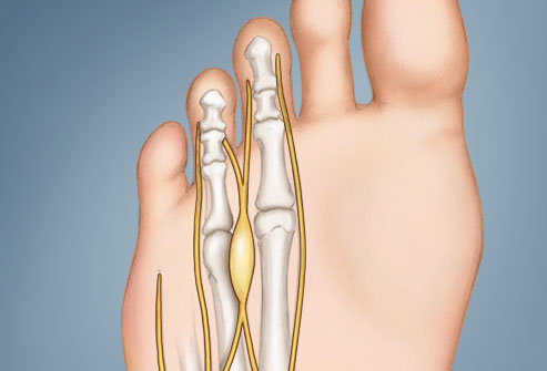 درد در انگشتان کوچکتر پا