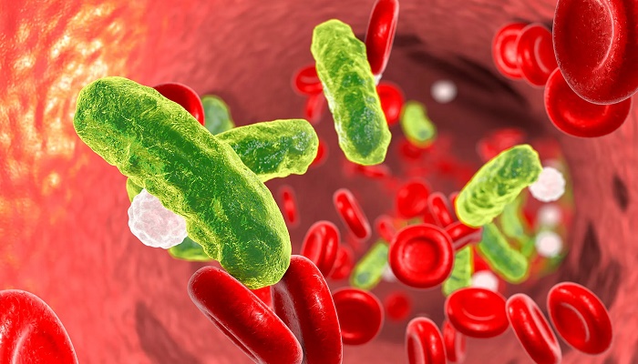 عفونت سپسیس چیست؟ عفونت سپسیس چیست؟