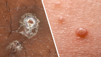 مولوسکوم کنتاژیوزوم؛ علایم و راه های درمان