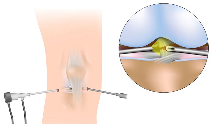 آرتروسکوپی چیست؟