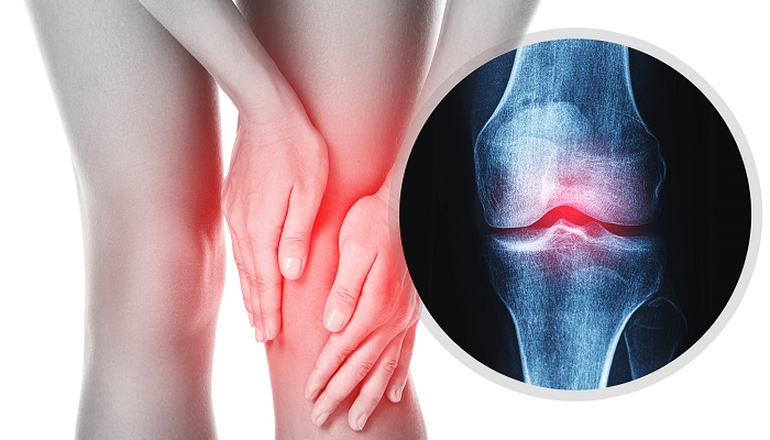 آرتروز چیست و چه علایمی دارد؟ آرتروز چیست و چه علایمی دارد؟