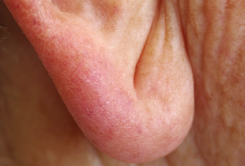 چین نرمه گوش چین نرمه گوش