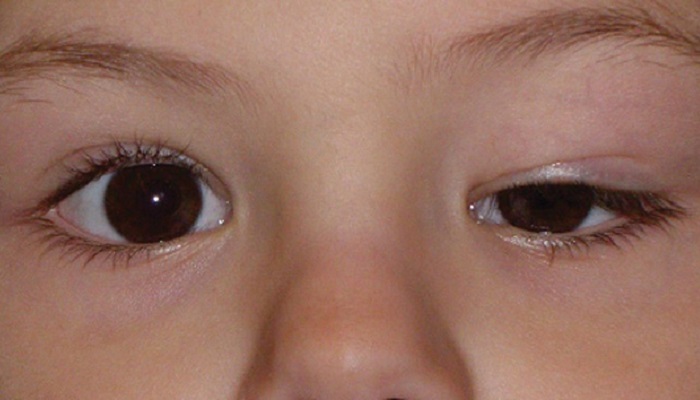 افتادگی پلک از عوامل اصلی تنبلی چشم کودکان