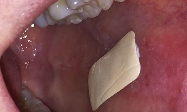درمان ضایعات دهانی با ابداع پچی جدید