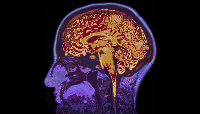 تجمع اوره در مغز عامل زوال عقل است تجمع اوره در مغز عامل زوال عقل است