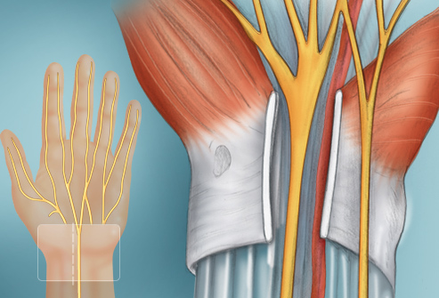 جراحی در سندرم تونل کارپال
