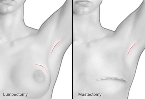 جراحی سرطان پستان