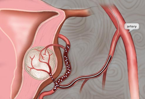 درمان: آمبولیزاسیون